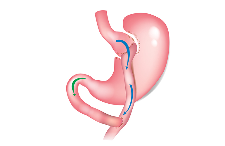 Fettleibigkeit und Stoffwechselchirurgie