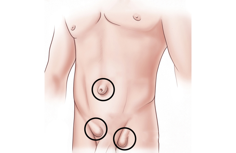 Bauchwandhernien